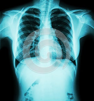 Film chest x-ray : show normal chest of woman