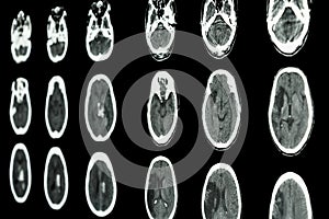 film CT scan of brain show ischemic stroke and hemorrhagic stroke photo