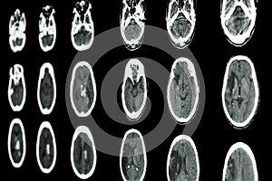 film CT scan of brain show ischemic stroke and hemorrhagic stroke