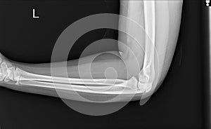 Film elbow AP a male 25 year old showed fracture photo