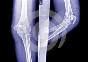 Film elbow AP showed fracture of elbow. photo