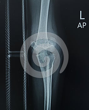 Film Elbow showing broken arm with humerus fracture .