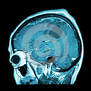 Film MRI of brain with brain tumor ( Sagittal plane , side view , lateral view ) ( Medical , Health care , Science Background ) photo