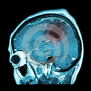 Film MRI of brain with brain tumor ( Sagittal plane , side view , lateral view ) ( Medical , Health care , Science Background ) photo