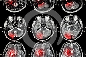 Film MRI ( Magnetic resonance imaging ) of brain ( stroke , brain tumor , cerebral infarction , intracerebral hemorrhage ) ( Medi