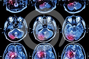 Film MRI ( Magnetic resonance imaging ) of brain ( stroke , brain tumor , cerebral infarction , intracerebral hemorrhage ) ( Medi photo