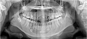 Film panoramic radiography view of the jaw