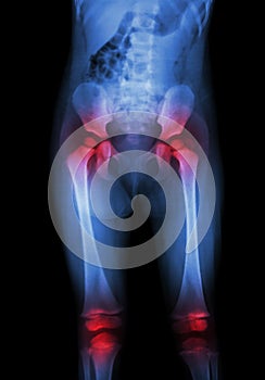 Film x-ray body of child (abdomen,buttock,thigh,knee) and arthritis at both hip , both knee (Gout,Rheumatoid)