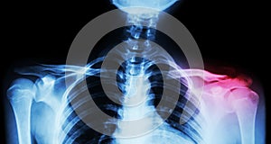 Film x-ray both clavicle AP ( front view ) : show fracture distal left clavicle