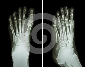 Film x-ray both foot ( 2 position : front view and side view )