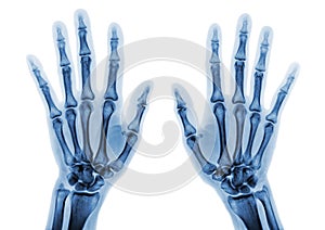 Film x-ray both hand AP show normal human hands on white background& x28; & x29;