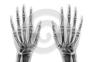 Film x-ray both hand AP show normal human hands on white background & x28; isolated & x29;