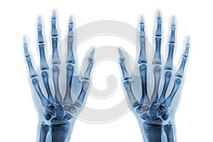 Film x-ray both hand AP show normal human hands on white background & x28; isolated & x29;