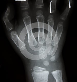 Film x-ray both hand AP : show normal human`s