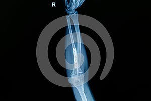 Film x-ray forearm fracture : show fracture ulnar bone with inserted plate