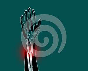 Film x-ray forearm simulating Photography finding fracture at left ulnar and left radial diaphysis with displacement on red mark.