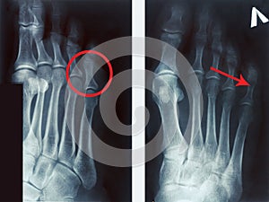 Film x-ray fracture proximal phalange at fifth toe