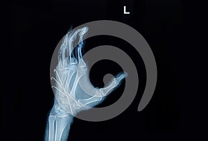 Film x-ray of hand fracture : show fracture metacarpal bone insert with k-wire (Kirschner wire)