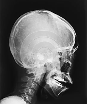 Film X-ray image of head