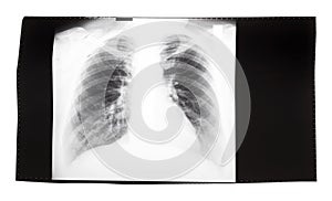 Film with X-ray image of human thorax