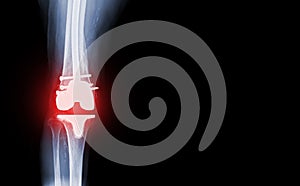 film x-ray  knee AP  view of osteoarthritis knee patient and artificial joint with Knee Replacement