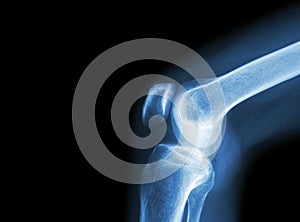 Film x-ray knee joint with arthritis ( Gout , Rheumatoid arthritis , Septic arthritis , Osteoarthritis knee ) and blank area at le
