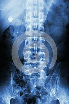 Film x-ray KUB Kidney - ureter - bladder show right renal stone round shape at left side