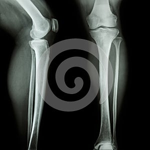 Film x-ray leg & knee AP/lateral