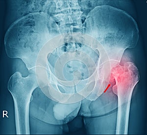 Film x-ray a male pelvis fracture and arthritis at left  hip joint