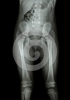 Film x-ray normal body of child (abdomen,buttock,thigh,knee)