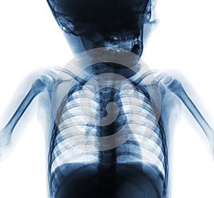 Film x-ray normal chest of baby . Upper half of body . Front view