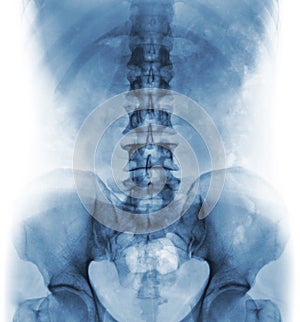 Film x-ray of normal human lumbar spine .