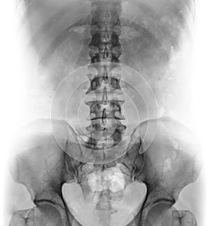 Film x-ray of normal human lumbar spine .