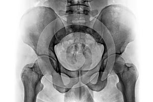 Film x-ray of normal human pelvis and hip joints