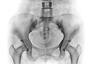 Film x-ray of normal human pelvis and hip joints