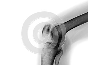 Film x-ray of normal knee joint