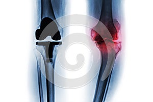 Film x-ray of osteoarthritis knee patient and artificial joint & x28; Total knee replacement & x29; . background