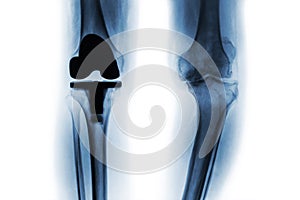 Film x-ray of osteoarthritis knee patient and artificial joint & x28; Total knee replacement & x29; . Isolated background