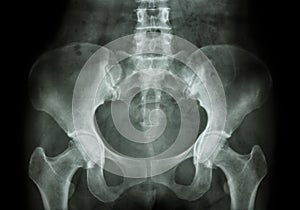 Film X-ray of Pelvis