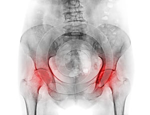 Film x-ray pelvis of osteoporosis patient and arthritis both hip