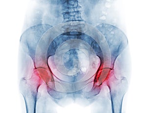 Film x-ray pelvis of osteoporosis patient and arthritis both hip