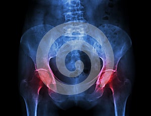 Film x-ray pelvis of osteoporosis patient and arthritis both hip