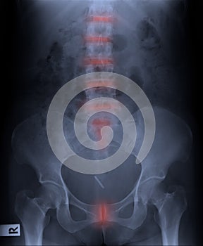 Film x-ray pelvis and spinal column.