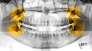 Film X-Ray scan human for tooth Impaction