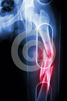 Film X-ray show comminute fracture shaft of femur (thigh bone). It was spliced