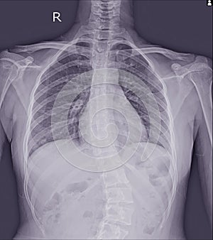 Film x-ray show spinal bend in teenager patient. Scoliosis disease.