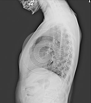 film x-ray show spinal bend in teenager patient. Scoliosis disease.