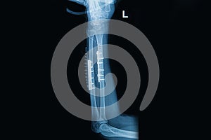 Film x-ray wrist fracture : fracture radius and ulnar