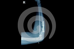 Film x-ray wrist fracture : show fracture radius bone