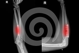 Film x-ray wrist fracture : show fracture radius bone (forearm's